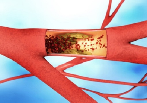 Ablagerung und Verengung einer Aterie - Arteriosklerose